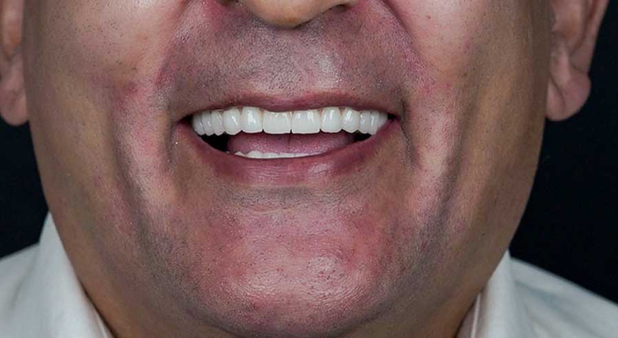 بعد از ایمپلنت